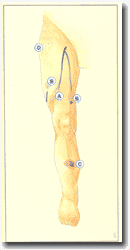 Рисунок 45.
Патогенез внутрикожного варикоза (A до D: смотри текст).