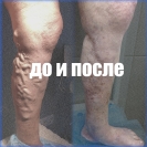 лазерная коагуляция магистральных вен и минифлебэктомия притоков