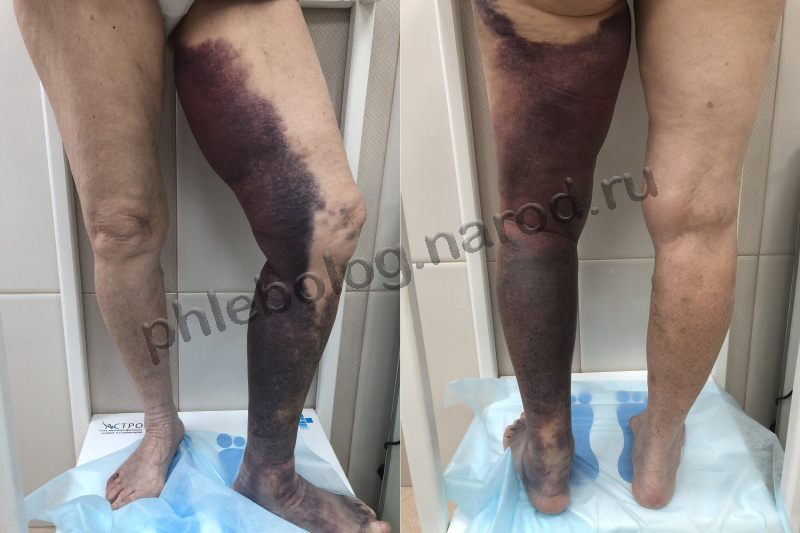 осложнения антикоагуляции