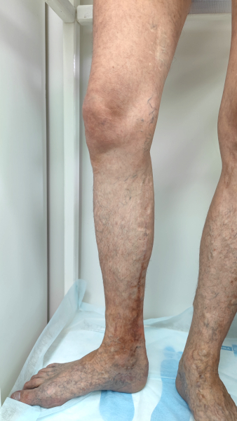 рубцы после флебэктомии